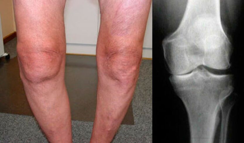 artróza kolenného kĺbu
