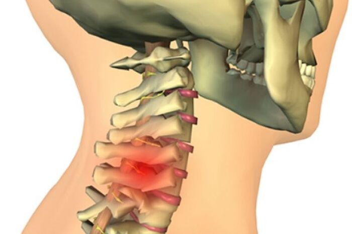 bolesť krku v dôsledku osteoartrózy