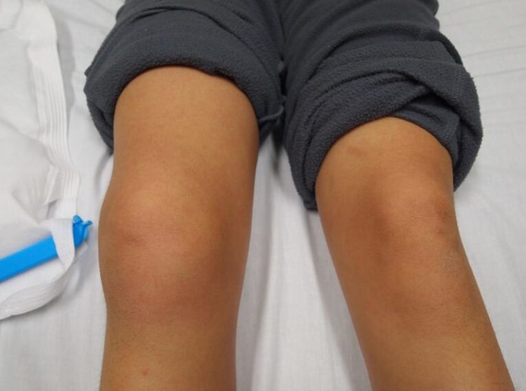 deformácia kolenného kĺbu s artrózou