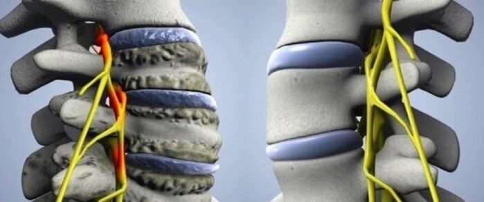zdravá a postihnutá chrbtica s artrózou
