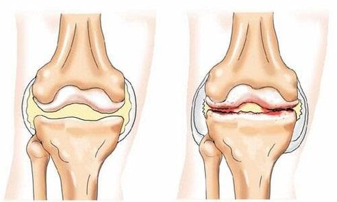 zdravý a artrotický kolenný kĺb